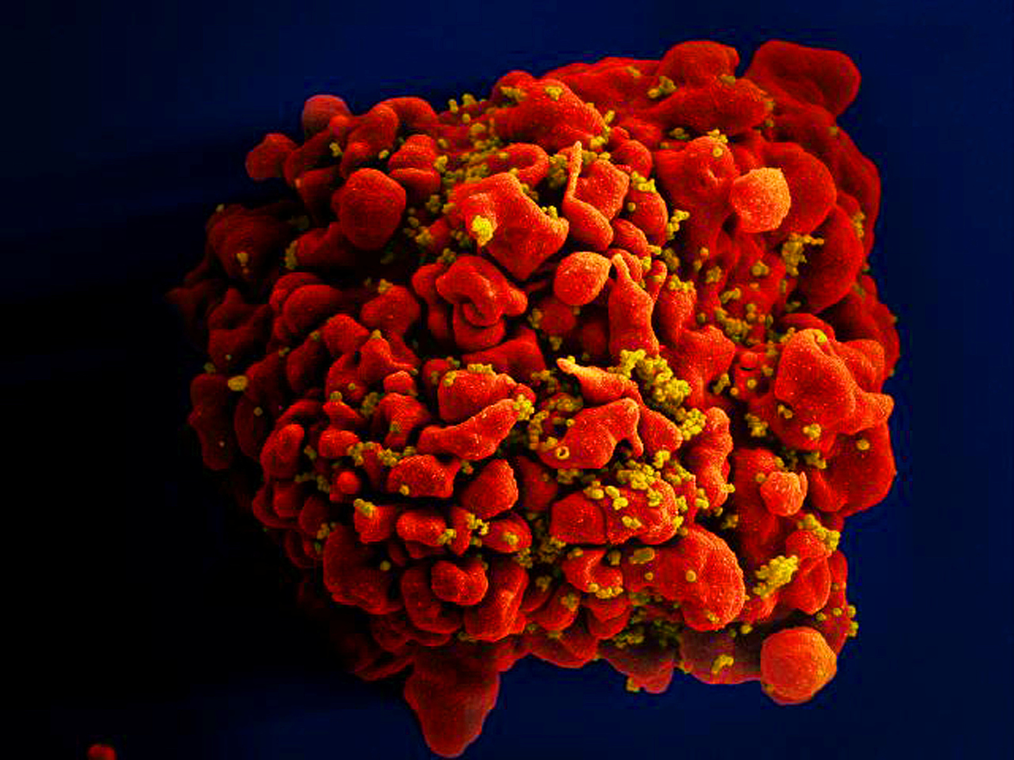 未來愛滋病有望痊癒？美國公布首位女性愛滋病毒治癒者案例